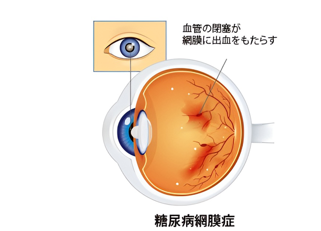 白内障