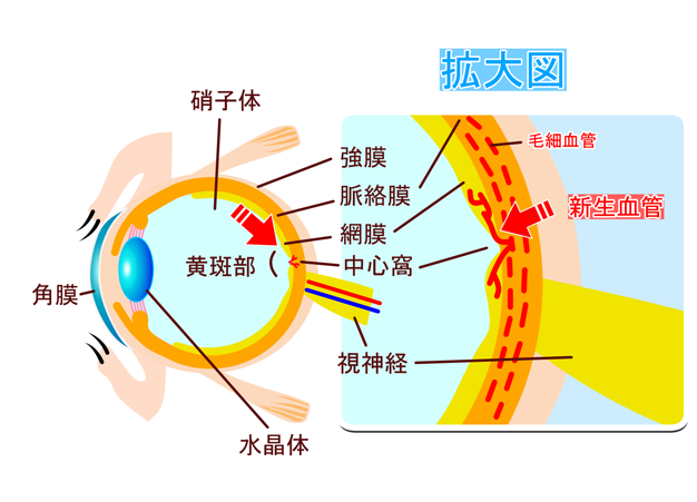 白内障